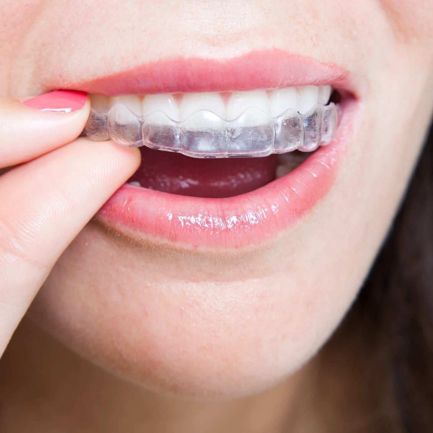 woman putting on invisalign clear aligners to straighten her teeth without braces